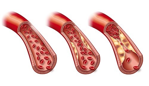 arteriosclerosis